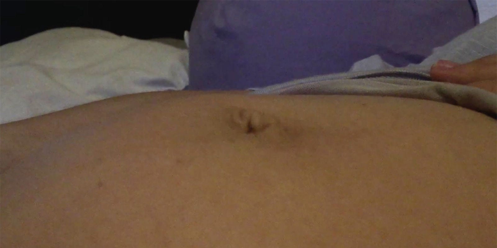 Dangerous umbilical pregnancy hernia during